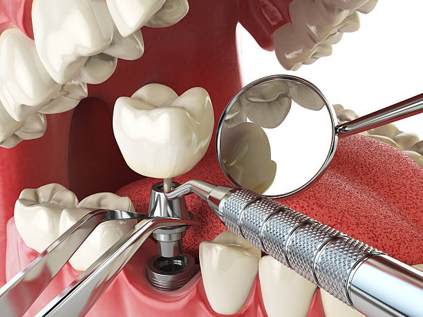 Best Emergency Tooth Extraction in West Point, UT
